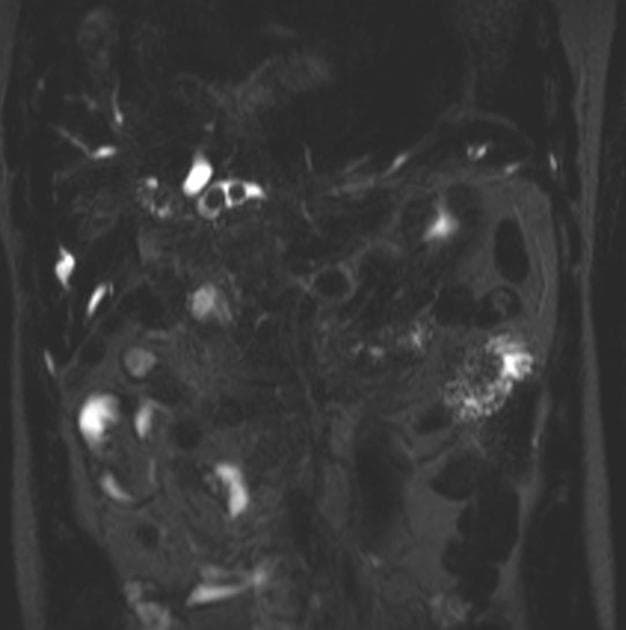 Caroli Disease with Medullary Sponge Kidney and Nephrocalcinosis (Bệnh Caroli kèm thận bọt tủy và vôi hóa thận)