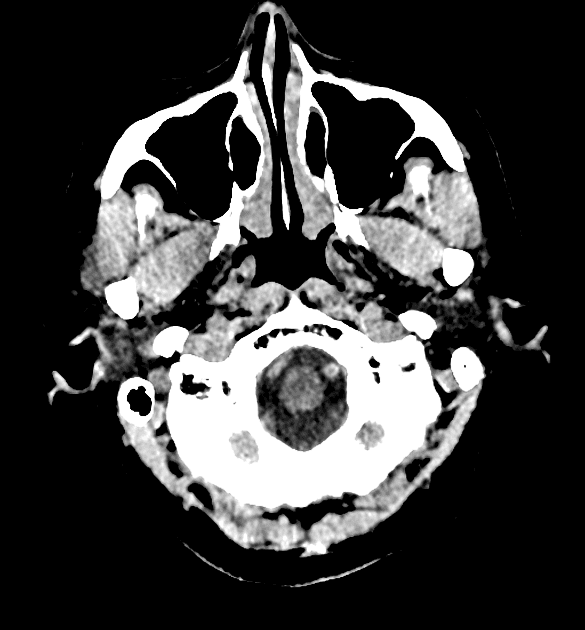Papillary craniopharyngioma - third ventricle