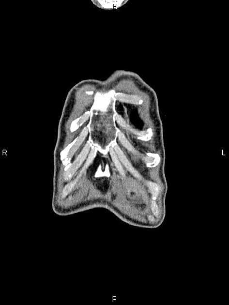 Pancreatic Adenocarcinoma with Vascular Encasement and Ascites (Ung thư tụy)