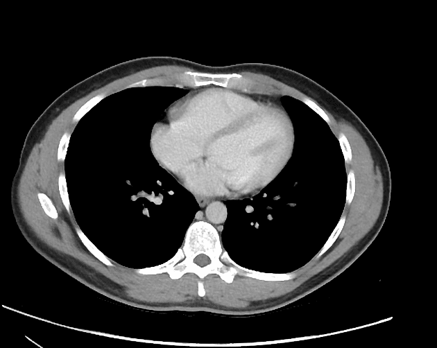 Pneumoperitoneum secondary to benign pneumatosis coli