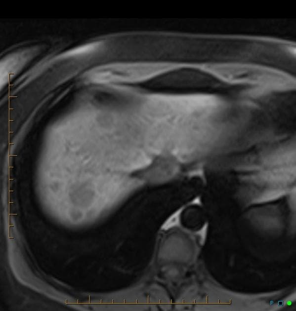 Hepatic adenomatosis