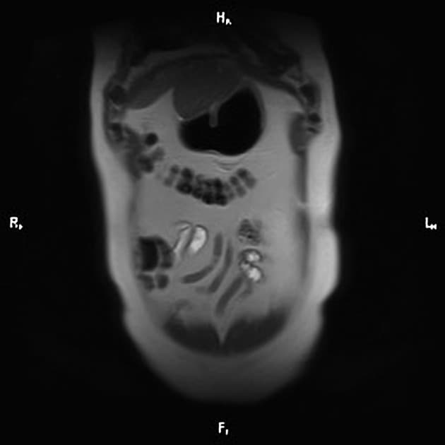 Renal Cystic Mass - Bosniak Class IV (Khối nang thận - phân loại Bosniak IV)