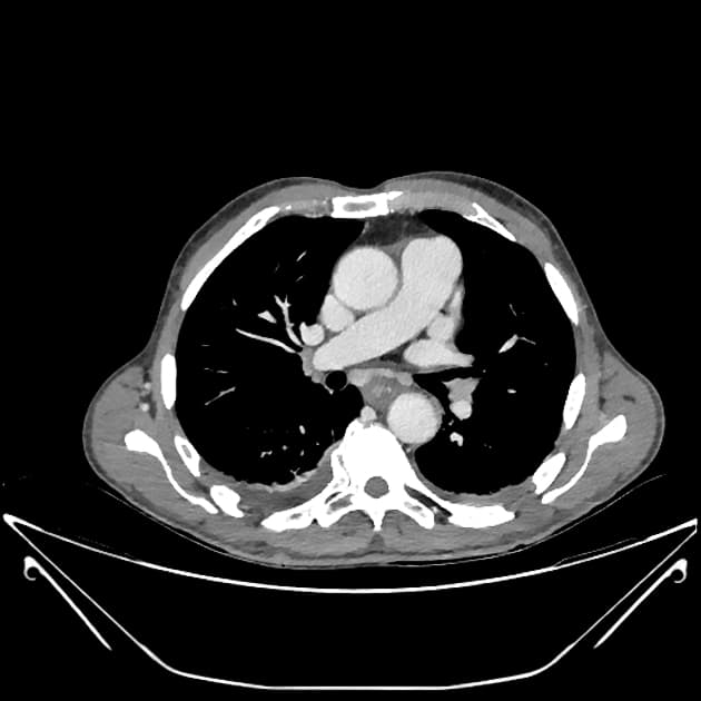 Ischemic bowel due to internal hernia with perforation