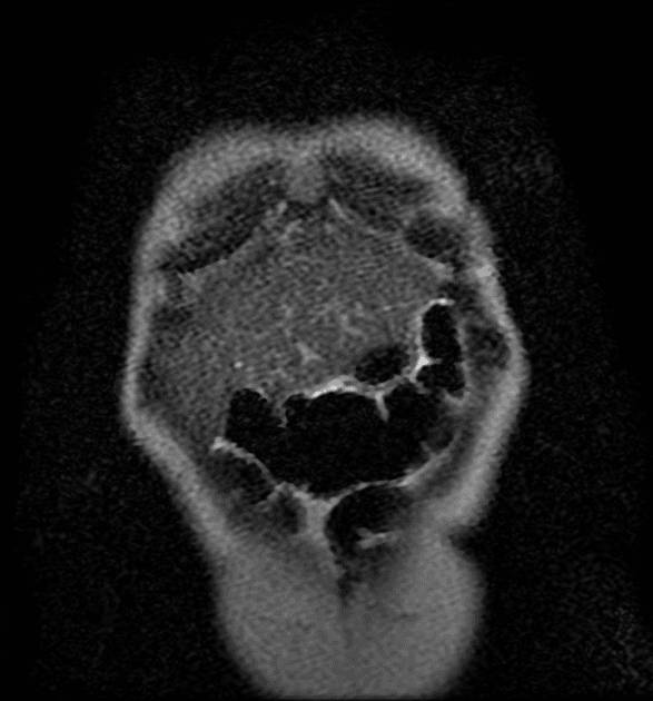 Choledochal Cyst - Type 4a (Nang ống mật chủ - type 4a)