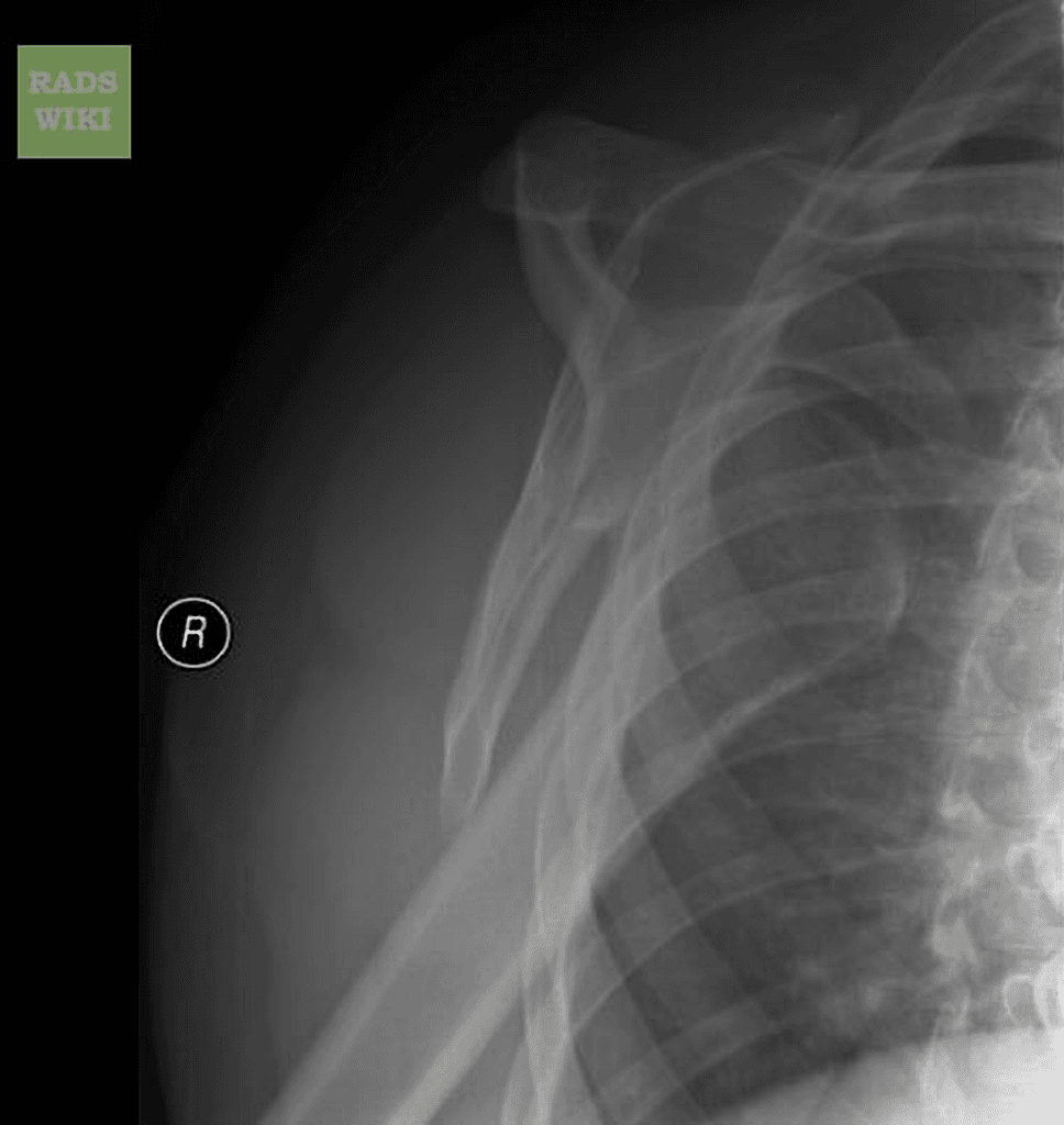 Anterior shoulder dislocation
