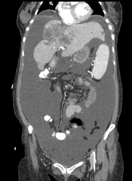 Ascites in Cholangiocarcinoma (Dịch ổ bụng)