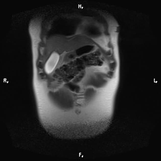 Von Hippel-Lindau Disease with Multisystem Involvement (Bệnh Von Hippel-Lindau)