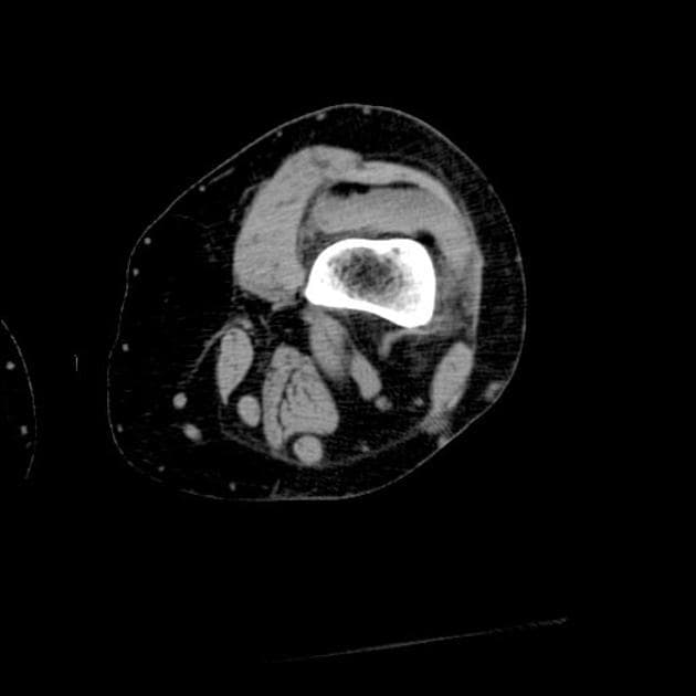 Lipohaemarthrosis in Knee Trauma (Lipohaemarthosis)