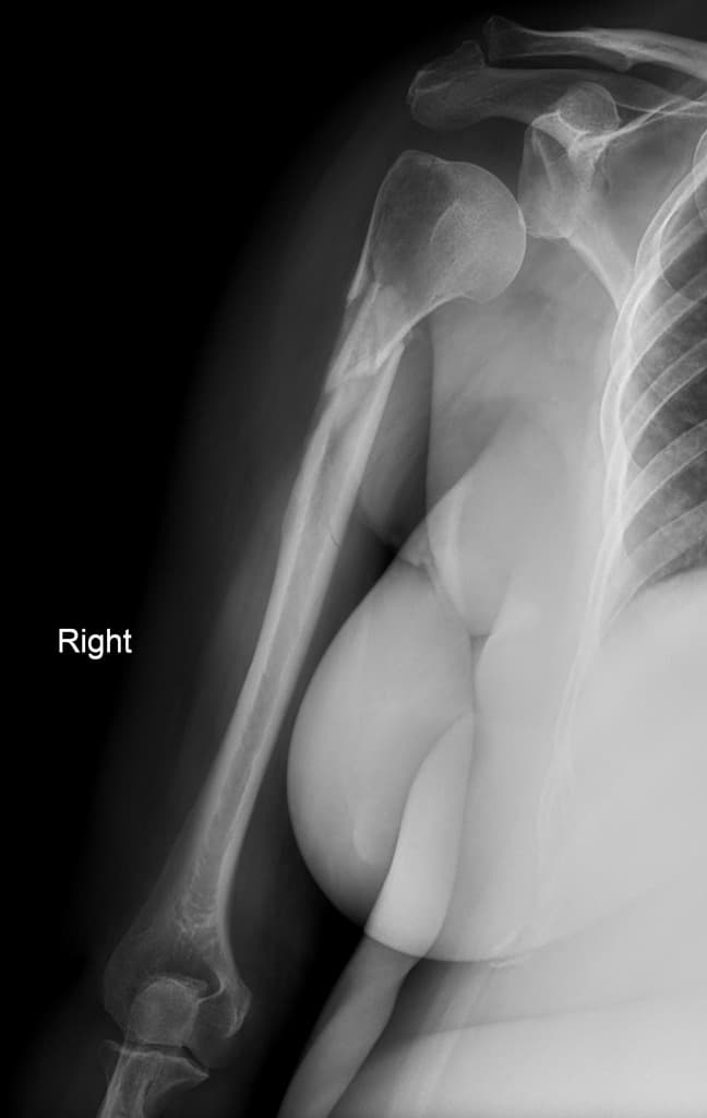 Comminuted humeral fracture