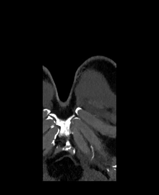 Aortic dissection with pulmonary artery intramural hematoma