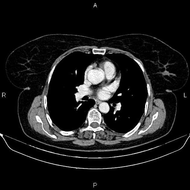 Pancreatic Endocrine Tumor (U tuyến nội tiết tụy)