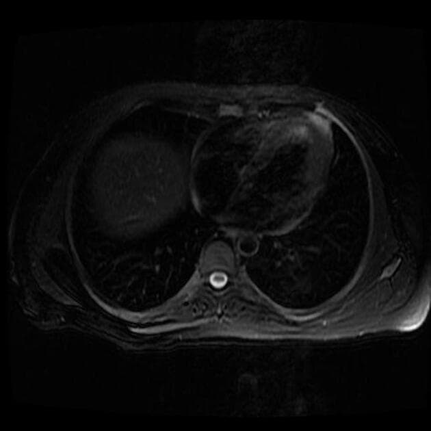 Cervical carcinoma - stage IIIC1