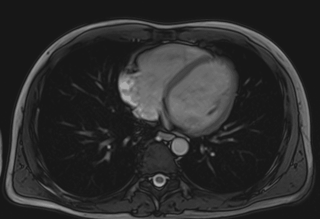 Crohn's disease with enterocolic fistulation