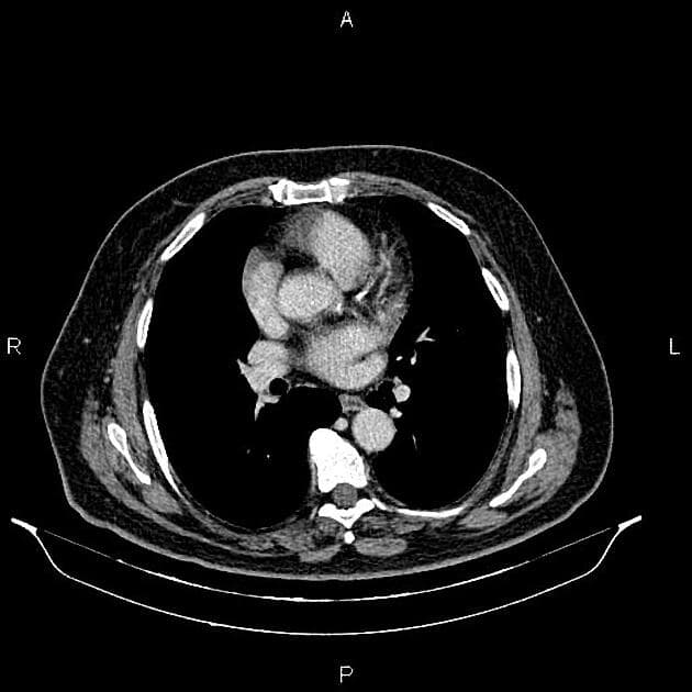 Renal Cell Carcinoma with Collecting System Involvement (Ung thư tế bào thận xâm lấn hệ thống đài bể thận)