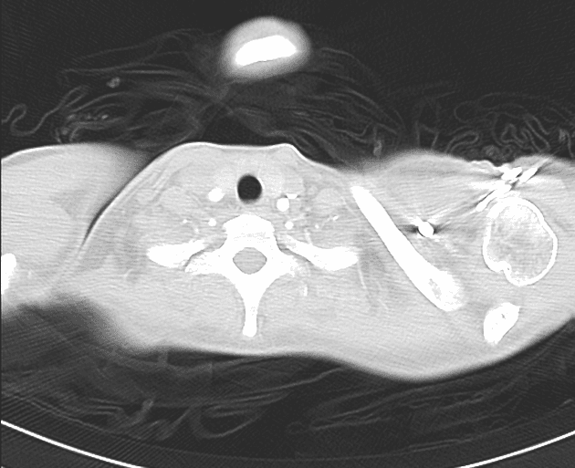 Pulmonary Artery Pseudoaneurysm in Pulmonary Mucormycosis (Phình động mạch giả phổi và nhiễm mucormycosis)