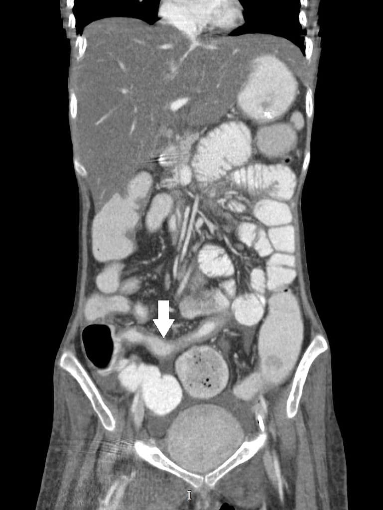 Terminal ileal tuberculosis
