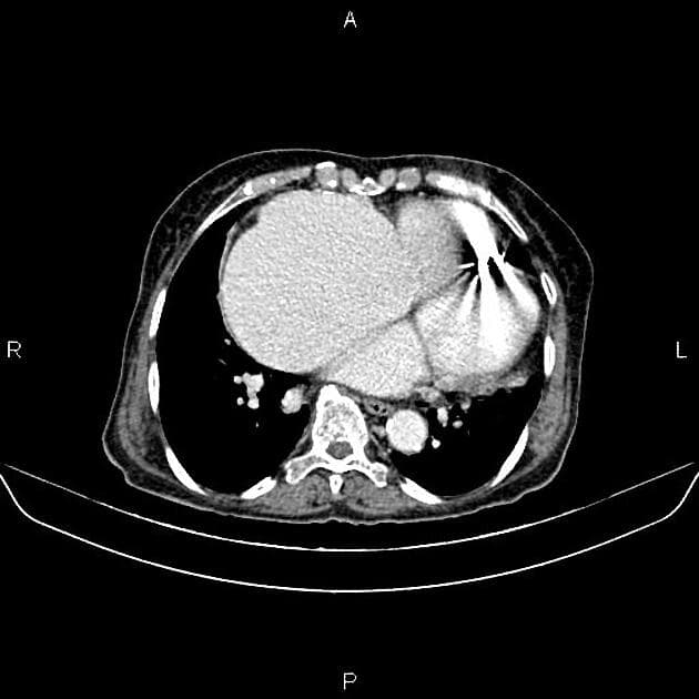 Renal Cell Carcinoma with Vascular Extension (Ung thư tế bào thận với sự lan rộng theo mạch máu)