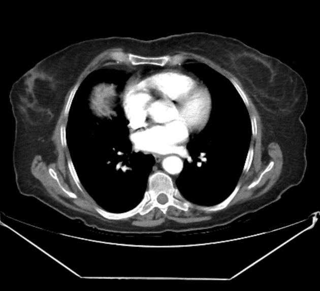 Hemorrhagic cholecystitis