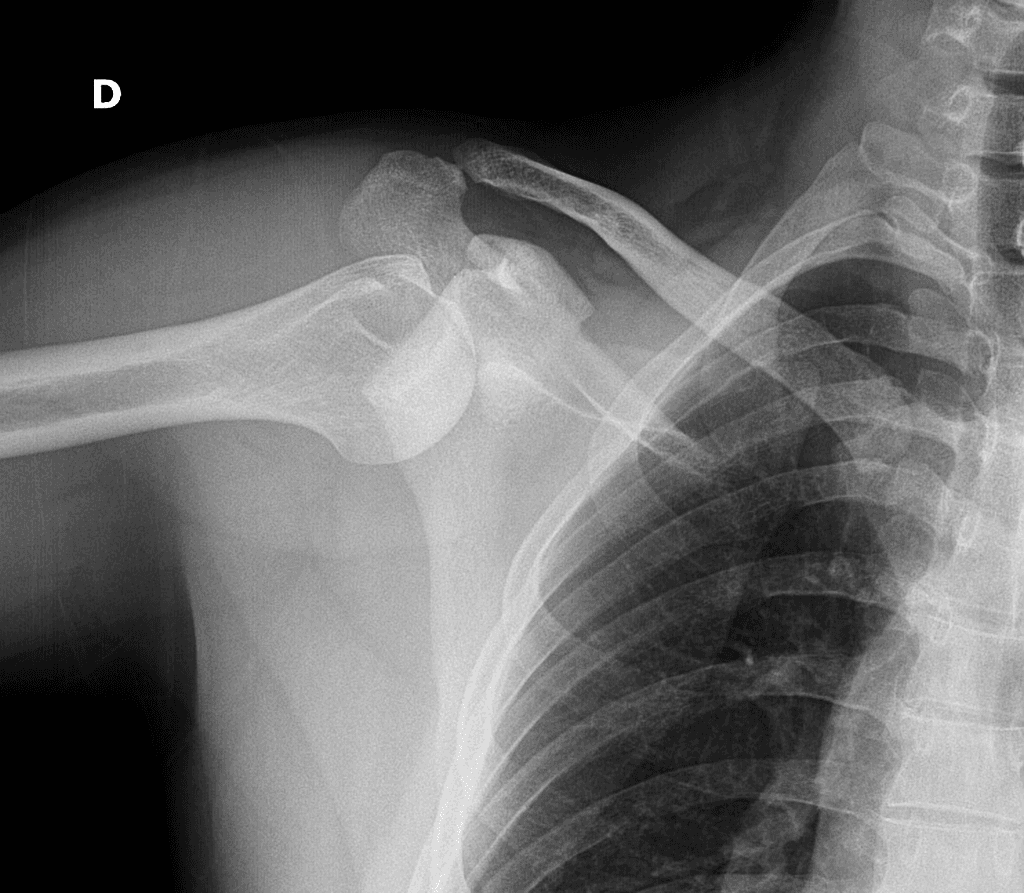 Inferior shoulder dislocation (luxatio erecta)