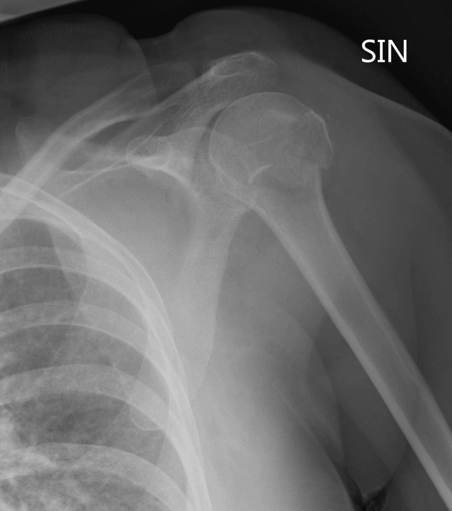 Luxatio erecta - inferior shoulder dislocation with fracture of proximal humerus