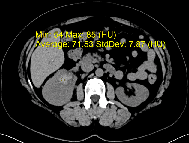 Primary Renal Lymphoma (U lympho thận nguyên phát)