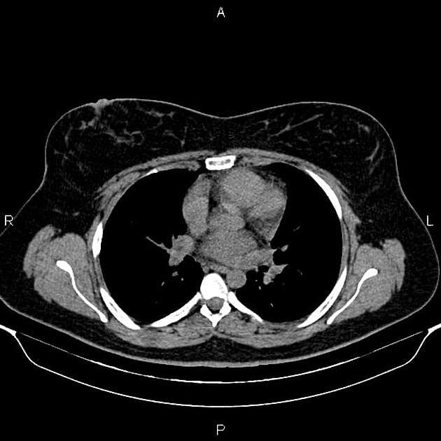Exophytic hepatocellular adenoma