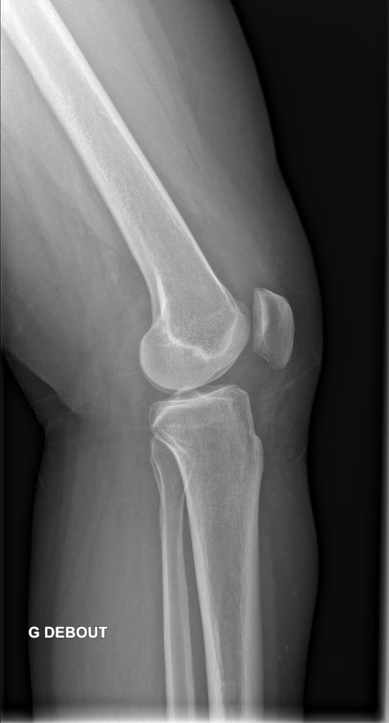 Bucket Handle Meniscal Tear of the Medial Meniscus (Vết rách sụn chêm dạng xô gánh)