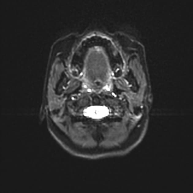 Cerebral Abscess with Frontal Bone Osteomyelitis and Frontal Sinusitis (Áp xe não)