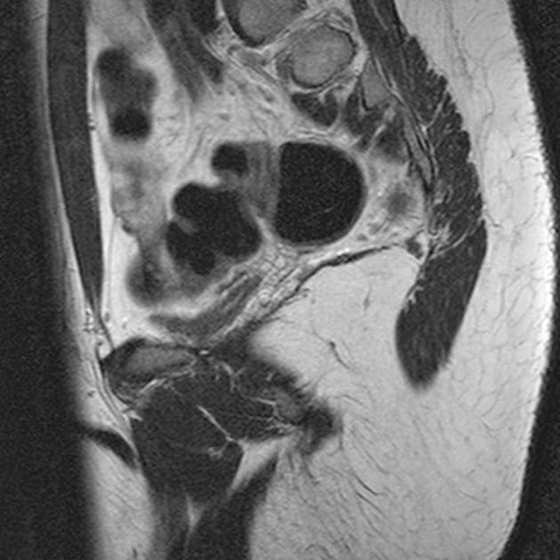 Mayer-Rokitansky-Küster-Hauser Syndrome (Hội chứng Mayer-Rokitansky-Küster-Hauser)