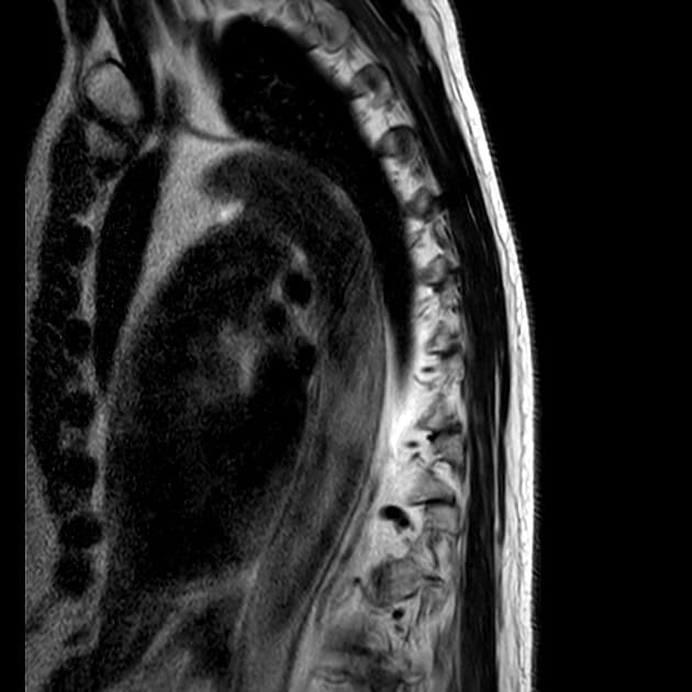 Von Hippel-Lindau Disease with Multisystem Involvement (Bệnh Von Hippel-Lindau)