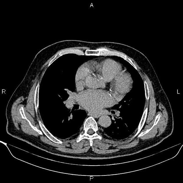 Renal Cyst - Bosniak Class IV (U nang thận - phân loại Bosniak IV)