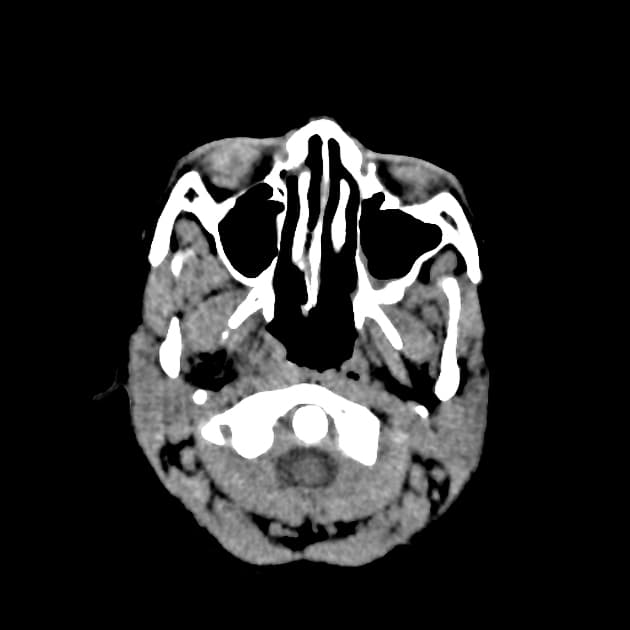 Mitochondrial encephalomyopathy with lactic acidosis and stroke-like episodes (MELAS)