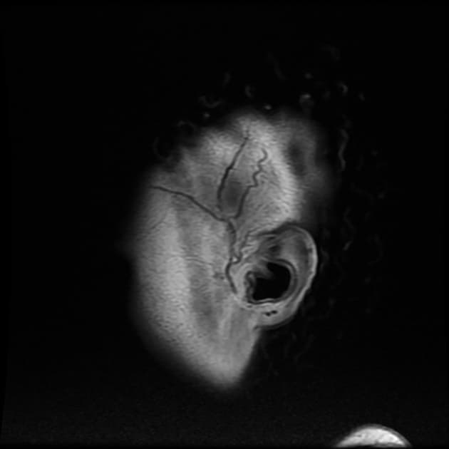 Chronic Migraine with New-Onset Left Hemiparesis (Migraine)