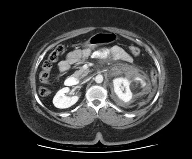 Retroperitoneal Hemorrhage from Renal Angiomyolipoma (Chảy máu khoảng sau phúc mạc do u mạch cơ mỡ thận)