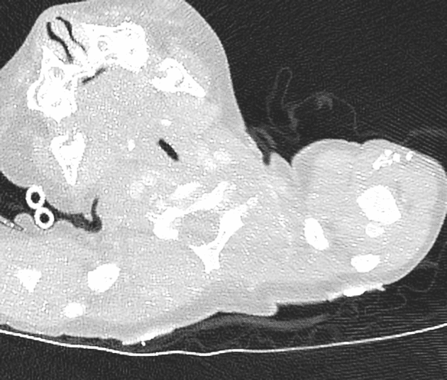 Kawasaki Disease with Coronary Artery Aneurysms (Bệnh Kawasaki)