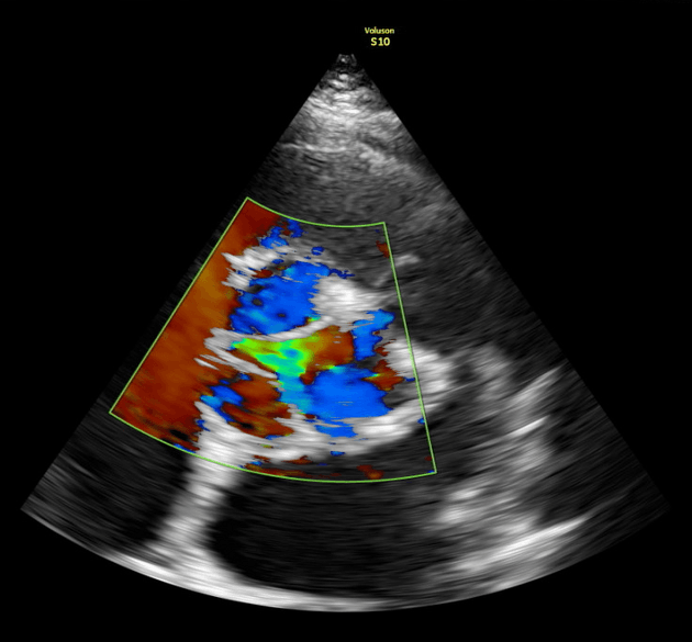 Aortic dissection - Stanford type B (echocardiography)