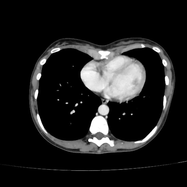Exophytic Renal Angiomyolipoma (U cơ mỡ mạch thận lồi ra ngoài)