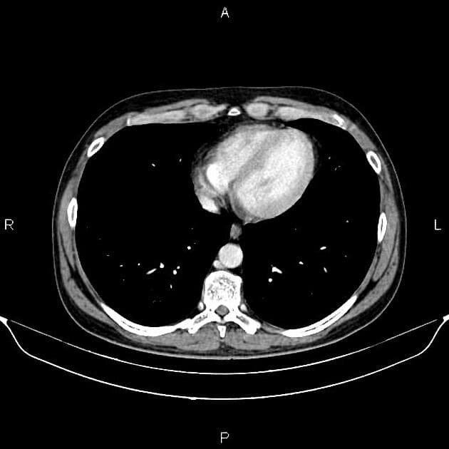 Acute peripancreatic fluid collections