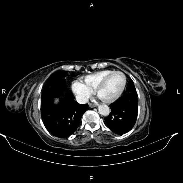 Cholangiocarcinoma (Ung thư tế bào gan đường mật)