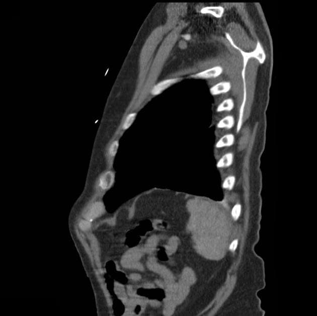 Aortic dissection with rupture into pericardium