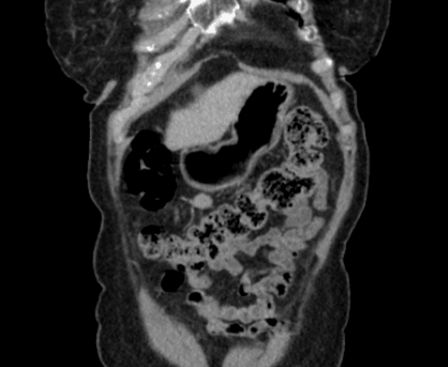 Hepatic hemangiomas