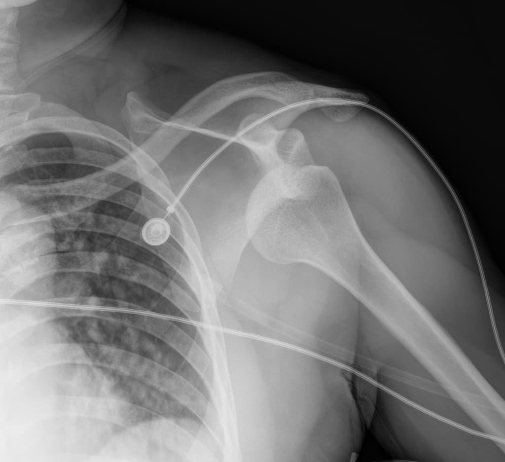 Bilateral anterior shoulder dislocation