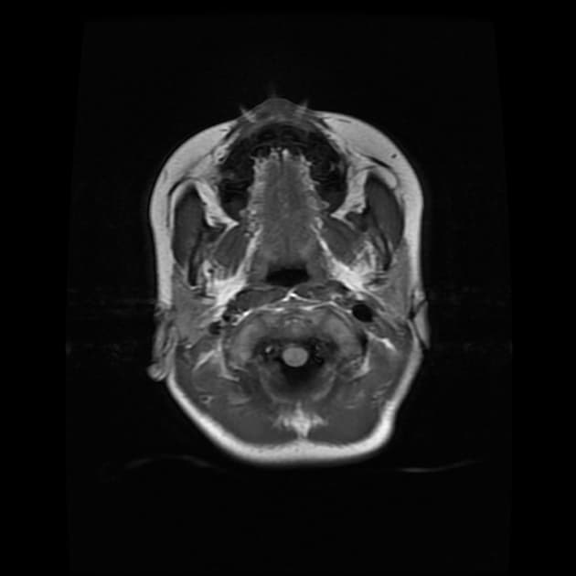 Myelin Oligodendrocyte Glycoprotein Antibody-Associated Disease (MOGAD) (Bệnh liên quan đến kháng thể myelin oligodendrocyte glycoprotein (MOGAD))