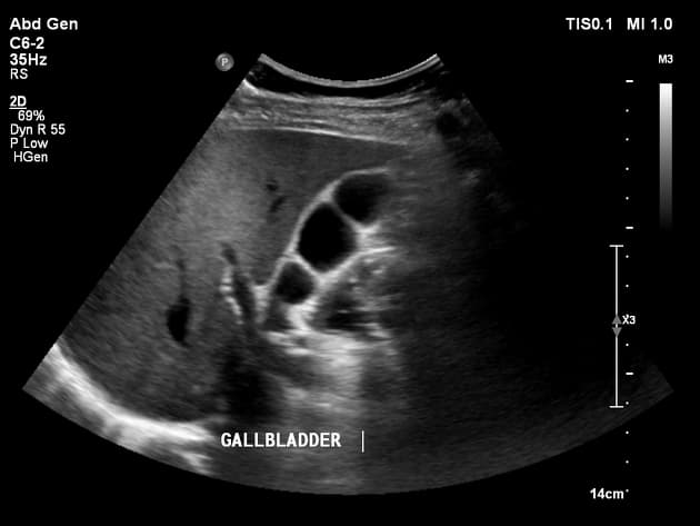 Septate Gallbladder (Túi mật vách ngăn)