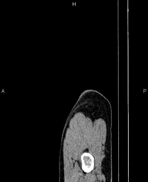 Locally Advanced Duodenal Adenocarcinoma (Ung thư biểu mô tuyến tá tràng giai đoạn tiến xa tại chỗ)