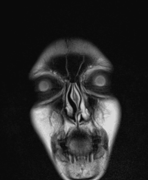 Brain metastases from breast cancer