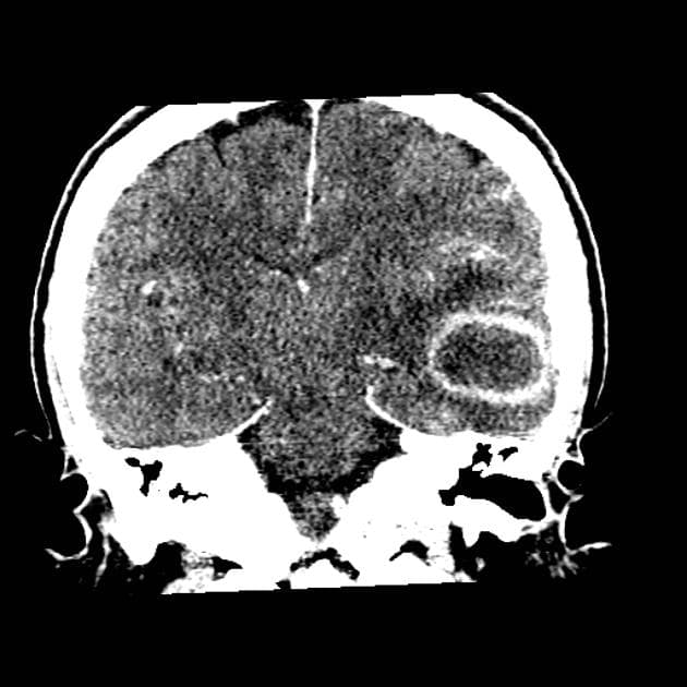Pyogenic Brain Abscess in Late Capsular Stage (Áp xe não (brain abscess))