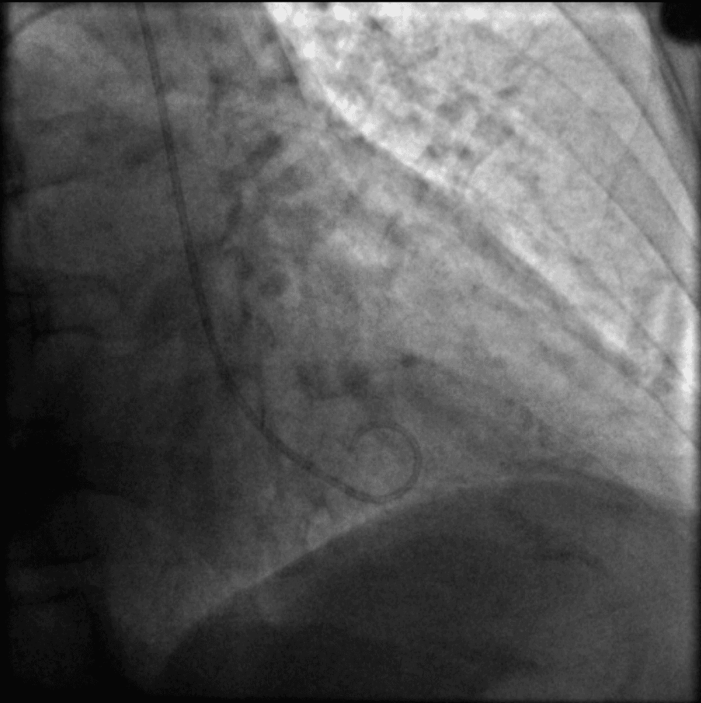 Takotsubo cardiomyopathy