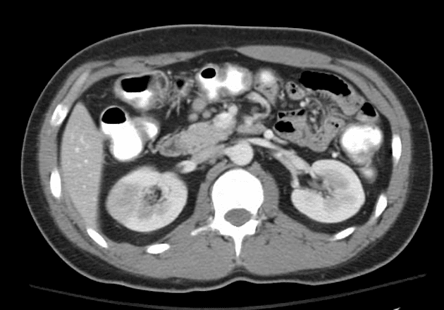 Renal Infarction Due to Renal Vein Thrombosis (Nhồi máu thận - huyết khối tĩnh mạch thận)