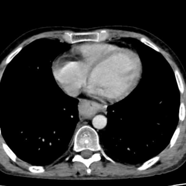 Fulminant Eosinophilic Esophagitis with Laryngopharyngeal Involvement (Viêm thực quản ái toan cấp tính với tổn thương lan tỏa đến hạ họng và thanh quản)